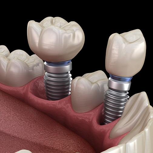 Illustration of two dental implants each with a crown atop them