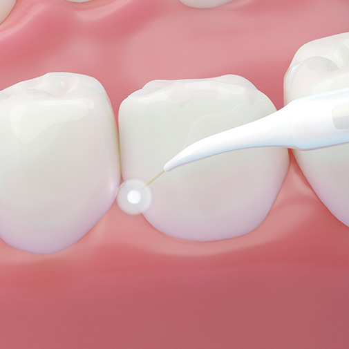 Illustration of a dental laser treating the gums
