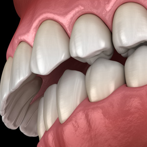 Illustration of a profile view of an overbite with black background