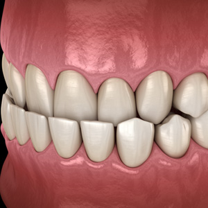 Illustration of an underbite with a black background
