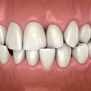 Illustration of a crossbite in upper and lower arches with black background