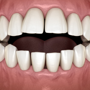 Illustration of a frontal view of an open bite with black background