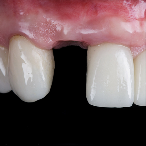 Close up of a mouth missing one upper tooth