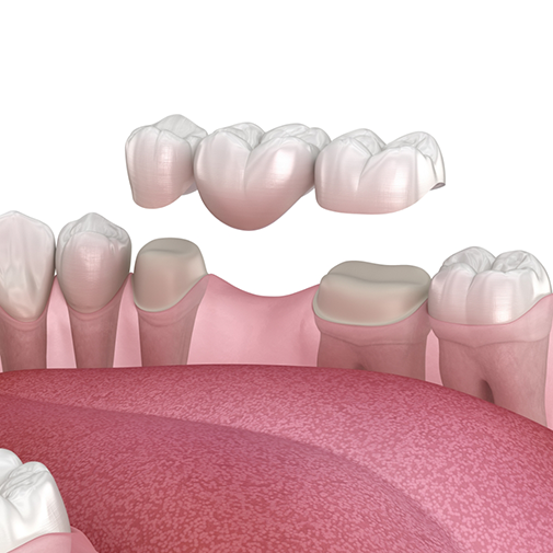 Illustration of a dental bridge being placed onto two teeth to fill the gap between them