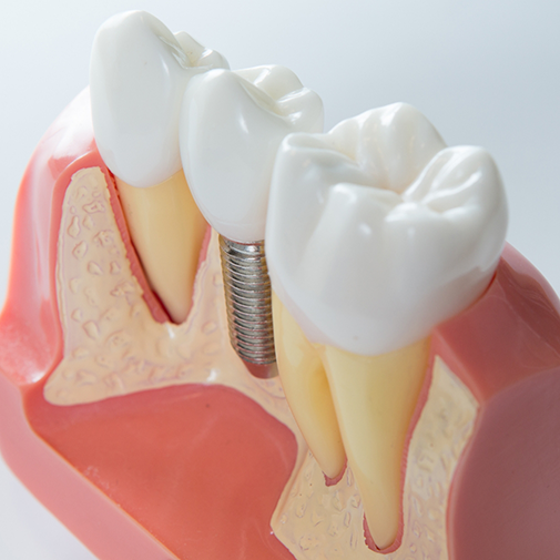 Model of a dental implant between two natural teeth
