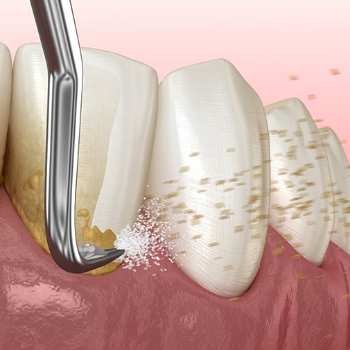 Illustration of a dental scaler clearing tartar buildup form the teeth and gums