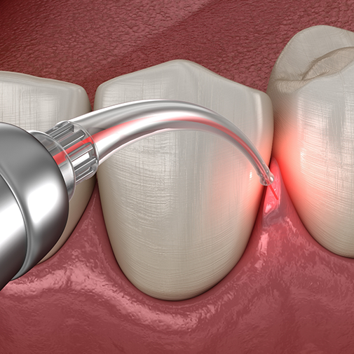 Illustration of a dental laser treating the gums