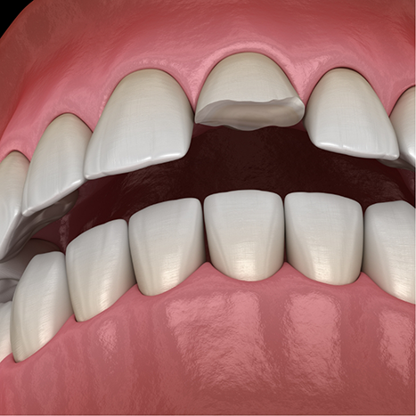 Illustration of a mouth with a chipped front tooth