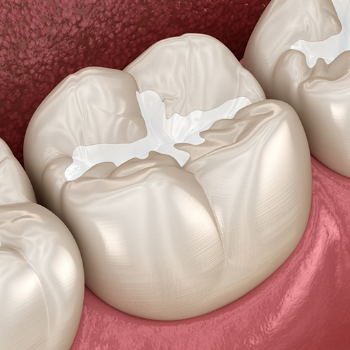 Illustrated row of teeth with dental sealants