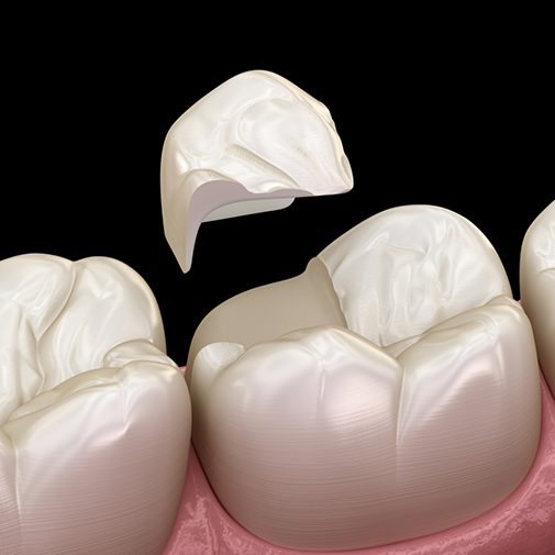 Illustration of a restoration being placed over a chipped tooth