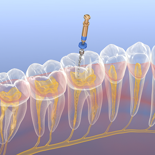 Illustration of a thin dental instrument treating the center of a tooth