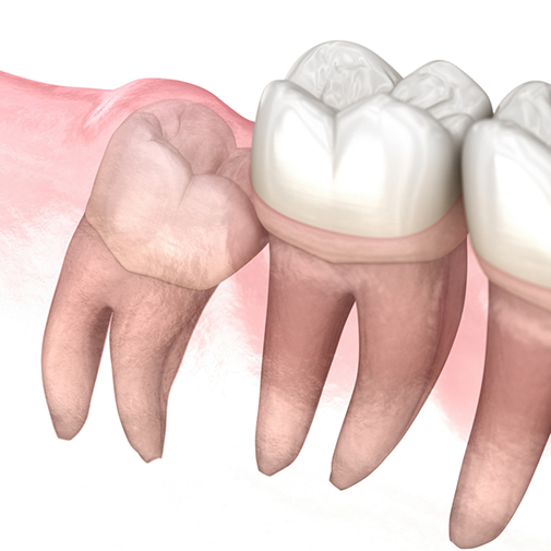 Illustration of an impacted tooth pressing sideways against the adjacent tooth